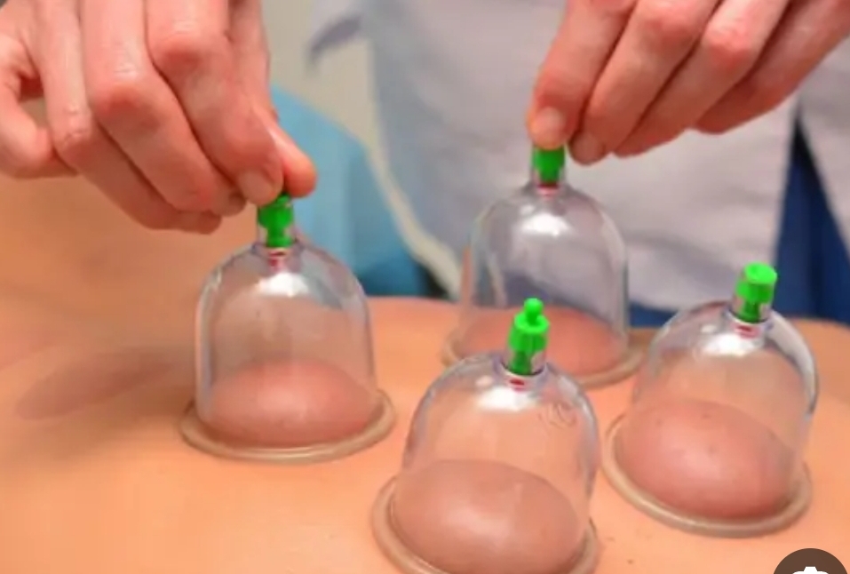 كورس تعلم الحجامة - Cupping therapy